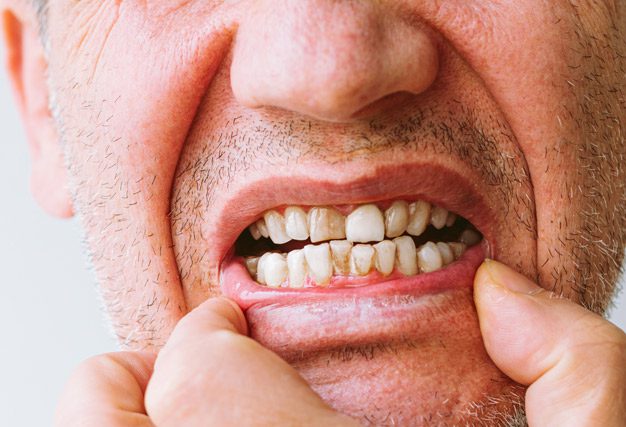 afecciones del tabaco en tus dientes