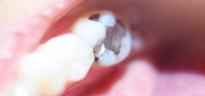 amalgama dental