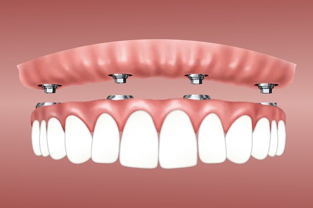 Implantes de dientes Madrid