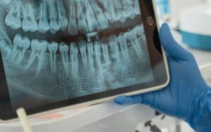 fenestración dental