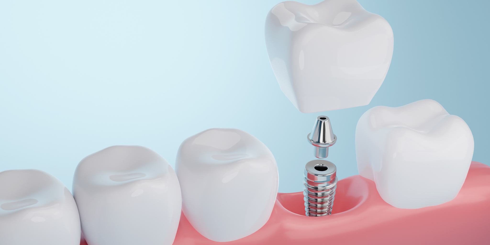 extracción e implantes dentales