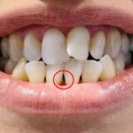 triangulos negros entre dientes