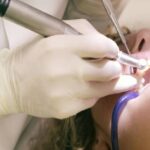 limpieza dental en Arguelles