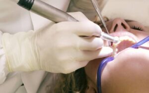 limpieza dental en Arguelles