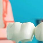 puentes dentales en arguelles