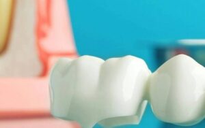 puentes dentales en arguelles