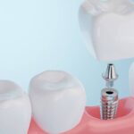 implantes dentales en Madrid