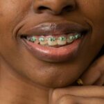 apiñamiento dental. Ortodoncia