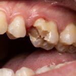 Qué Hacer Si Se Te Rompe Un Diente