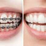 Brackets o Invisalign