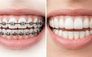 Brackets o Invisalign
