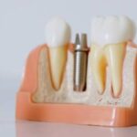 implantes dentales en Madrid
