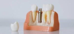 implantes dentales en Madrid