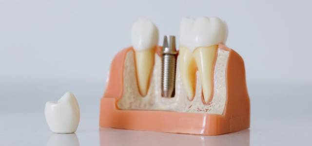 implantes dentales en Madrid